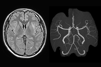 脳MRI検査の撮影画像